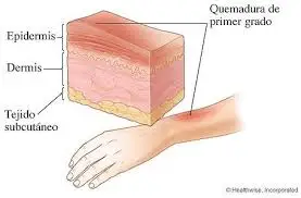 quemadura de primer grado epidermis grafico primeros auxilios